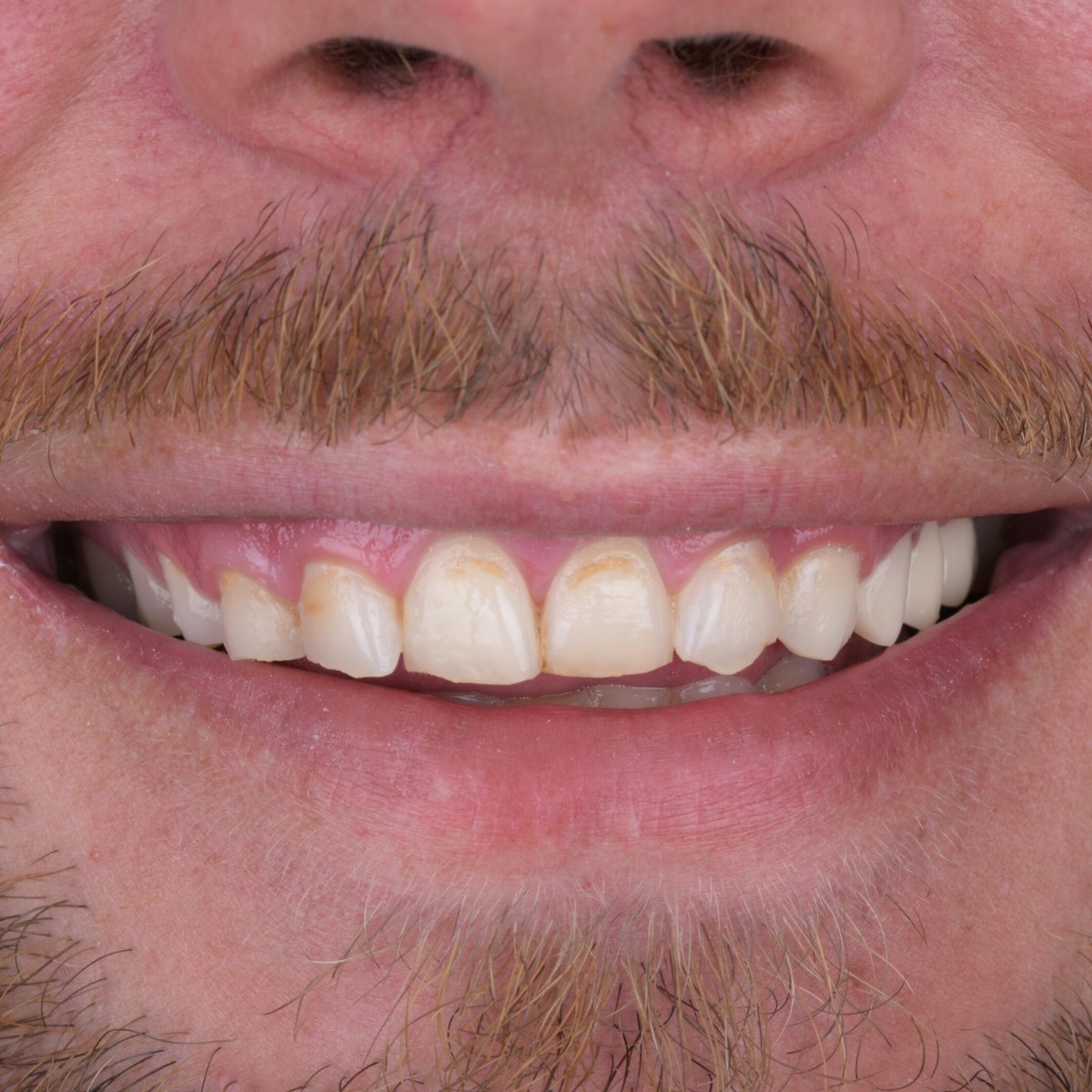 Before Before and after smile makeover at Perla Dental Clinics in Antalya