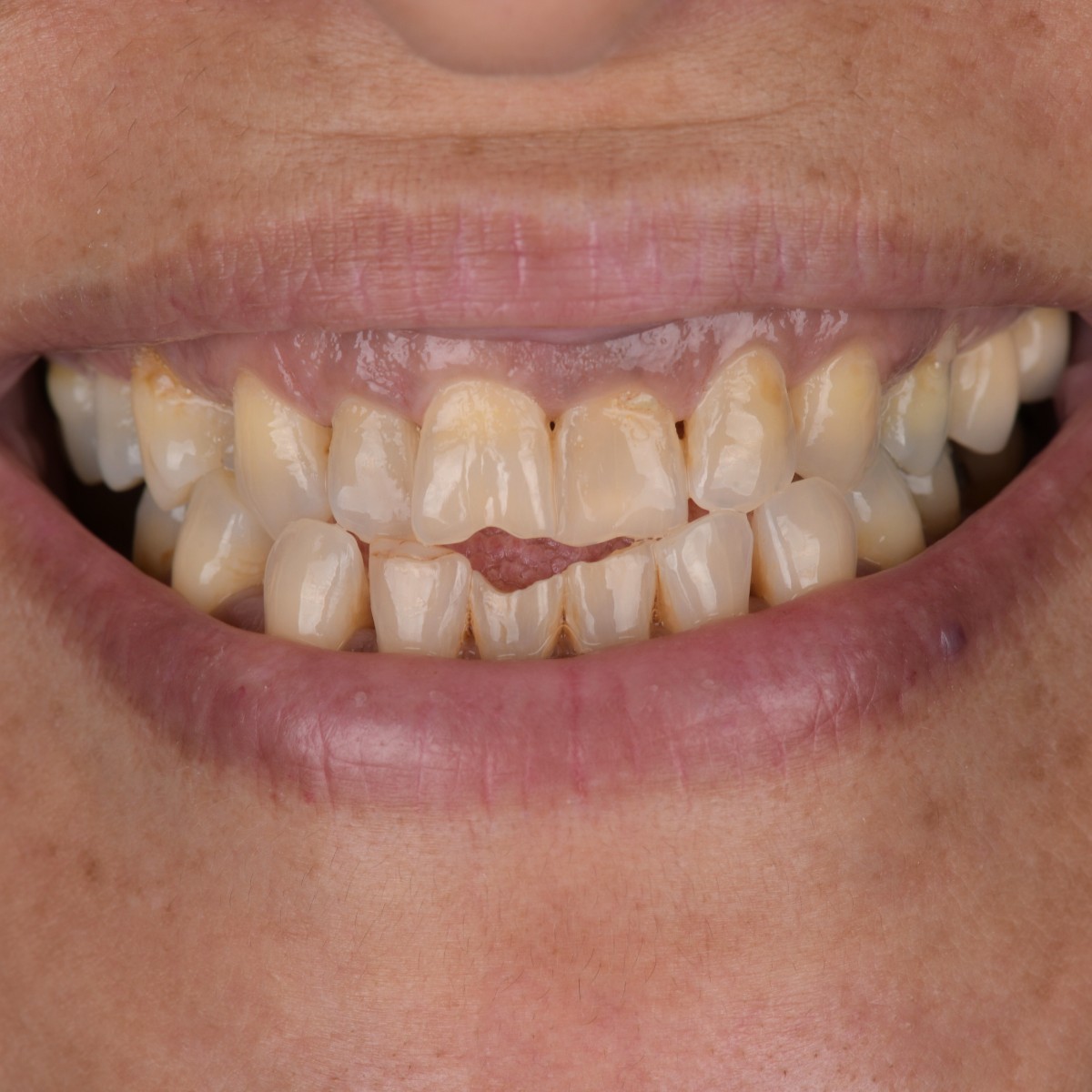 Before Dental veneers before and after at Antalya tourism dental clinic