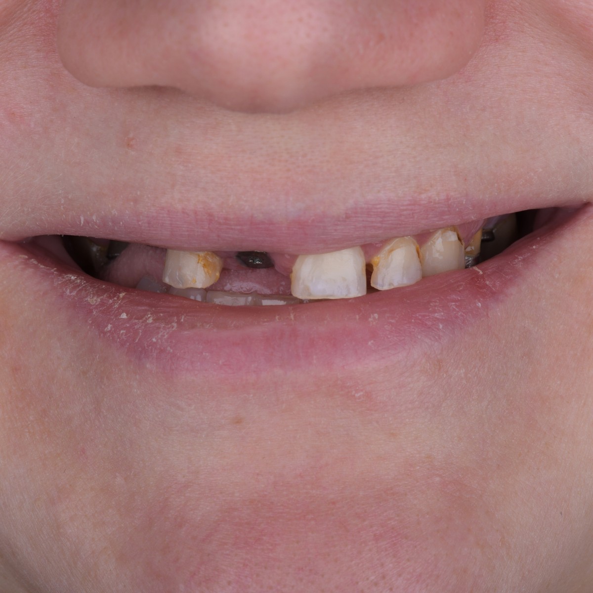 Before Holiday in Antalya dental treatment before after result