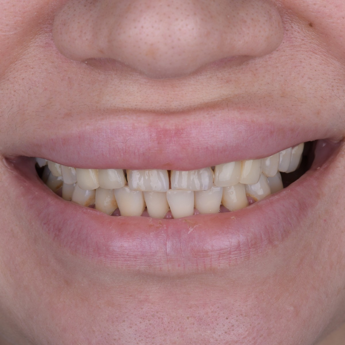 Before Perla Dental Clinics cosmetic dentistry before and after photo