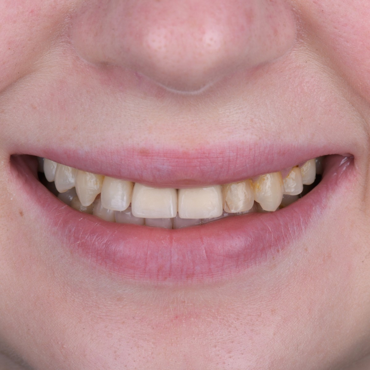 Before Antalya dental tourism braces transformation before after