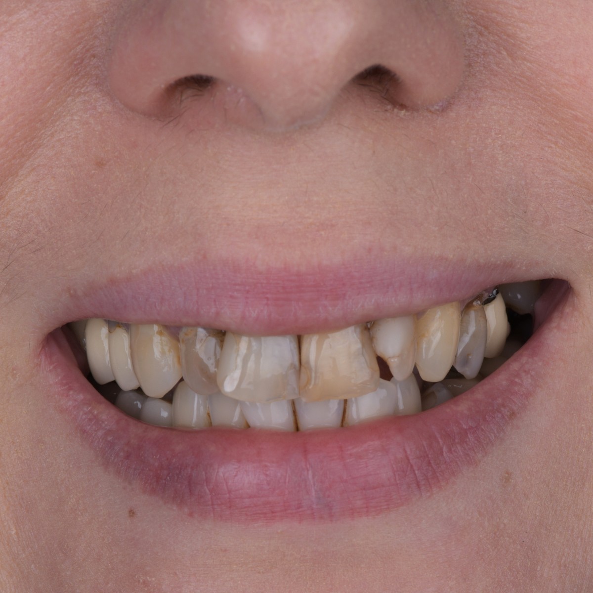 Before Smile design before after Perla Dental Clinics Antalya