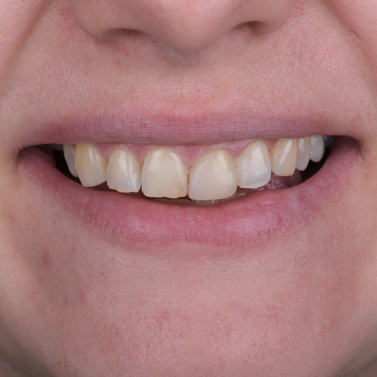 Before Antalya dental tourism braces transformation before after