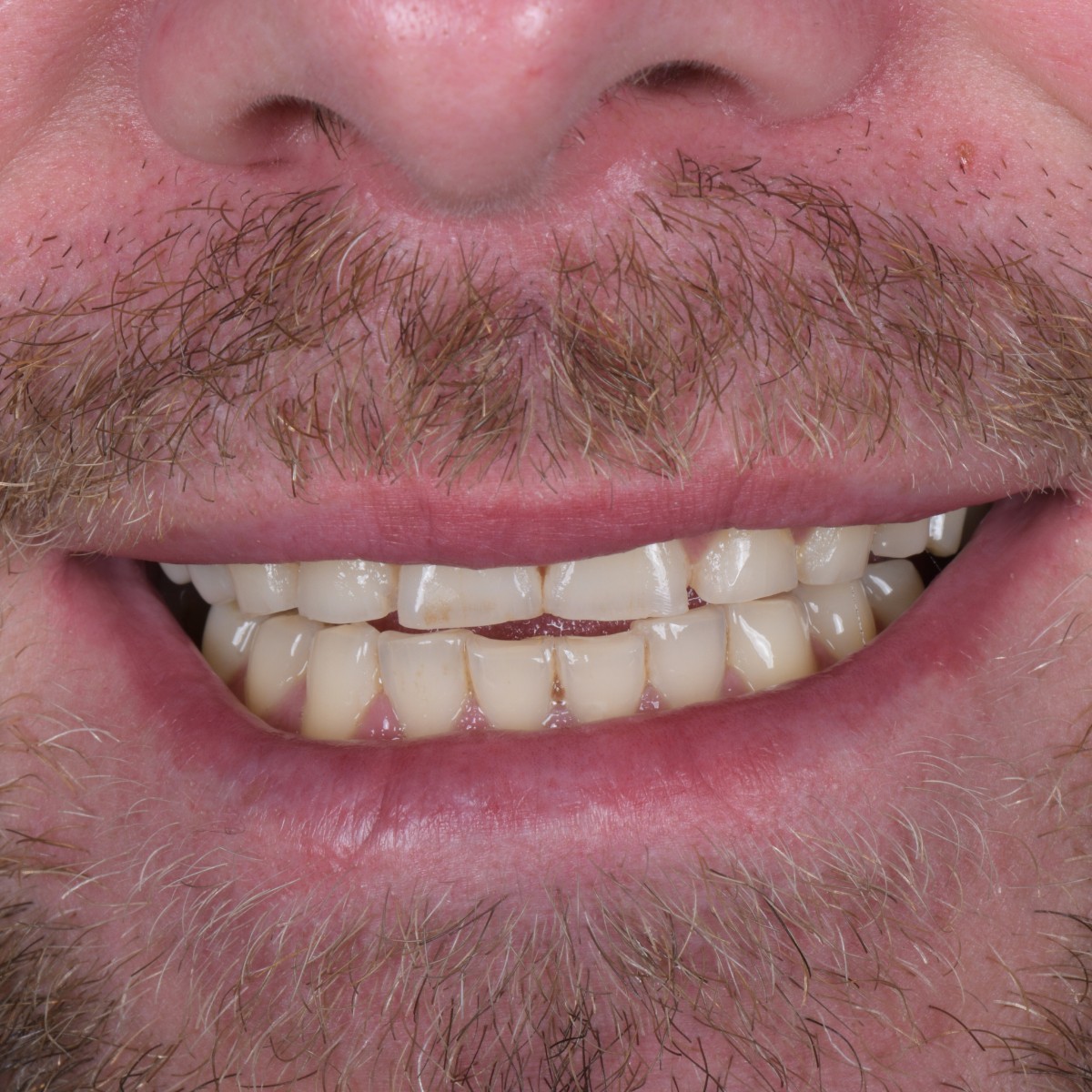 Before Before and after dental implants at Antalya holiday clinic