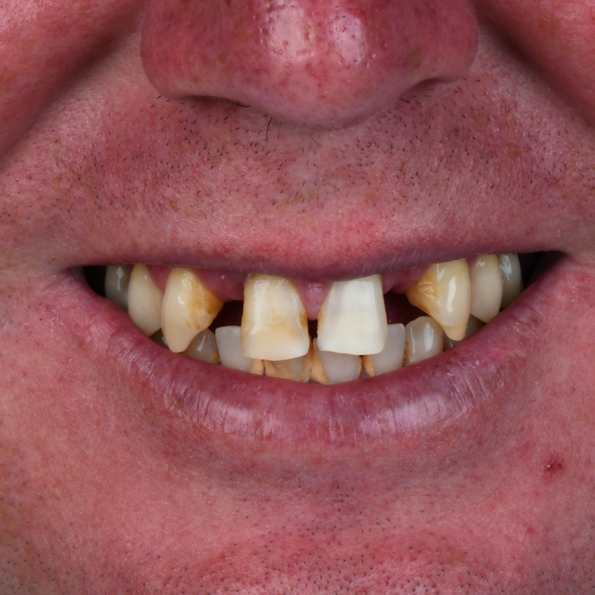 Before ourism dental clinic Antalya patient smile makeover photo