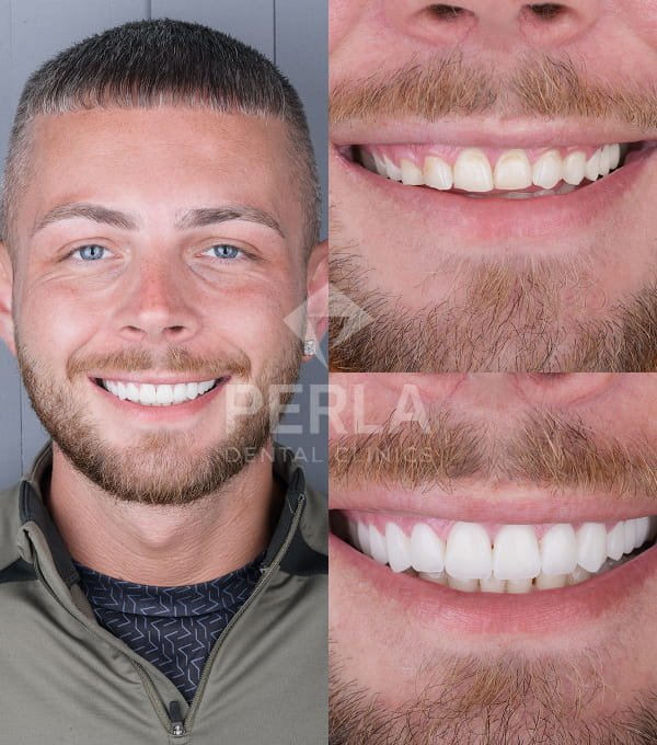 Anthony Dental Veneers