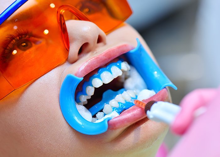 Application-of-Whitening-Gel