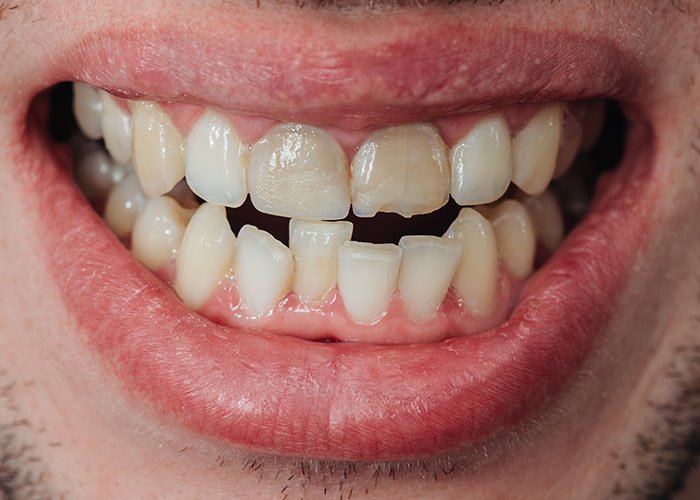 Chipped-or-cracked-teeth