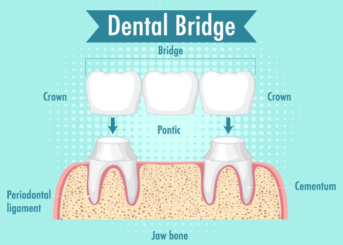 Treatments Dental Bridge