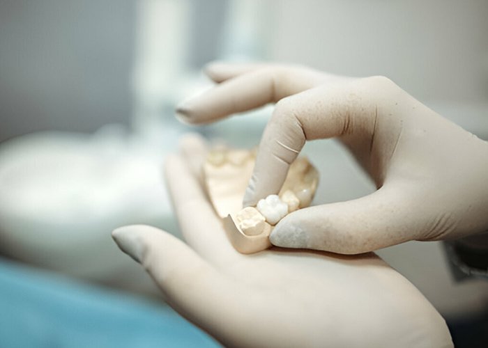 Treatments Dental Crown