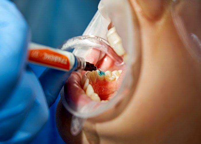 Treatments Dental-Filling
