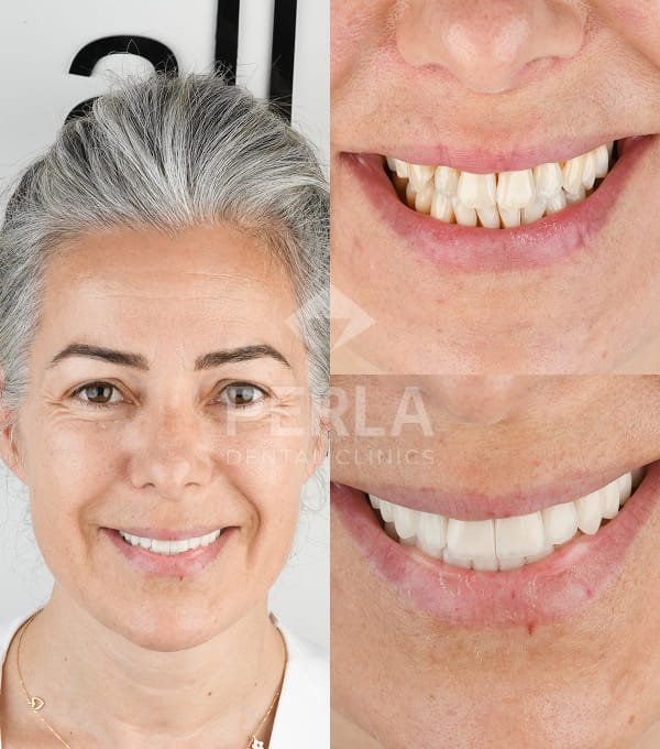 Dental Veneers 1