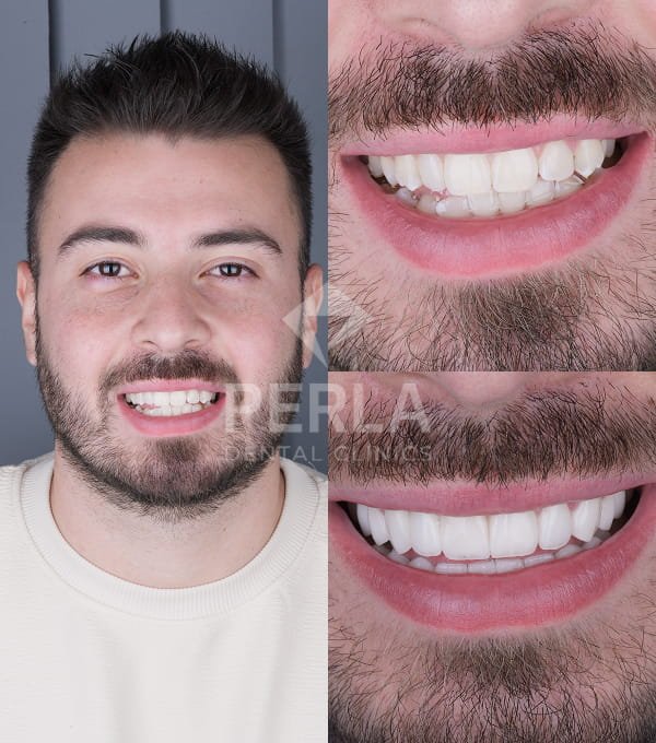 Dental veneers 2