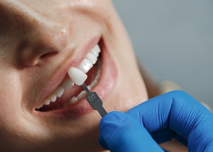 Treatments Emax Veneers1