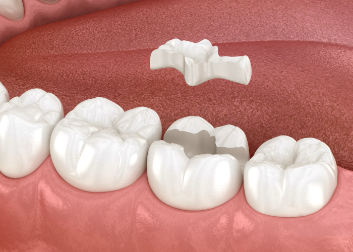 Treatments Inlay and Onlay