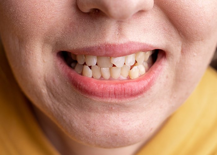 Misaligned-teeth