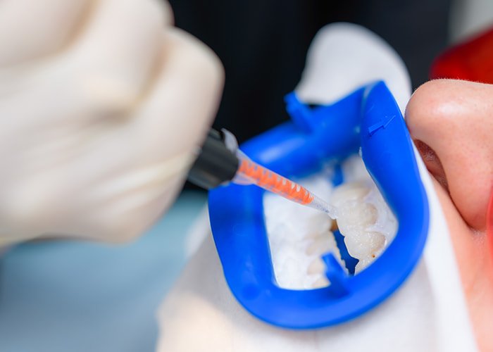 Professional-Whitening