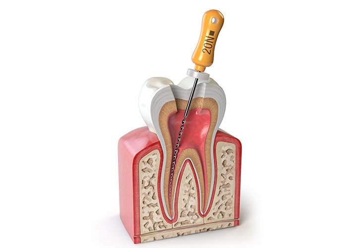 Treatments Root-Canal-Treatment