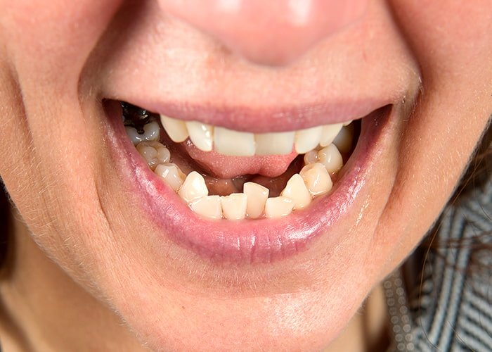 Worn-or-irregularly-shaped-teeth