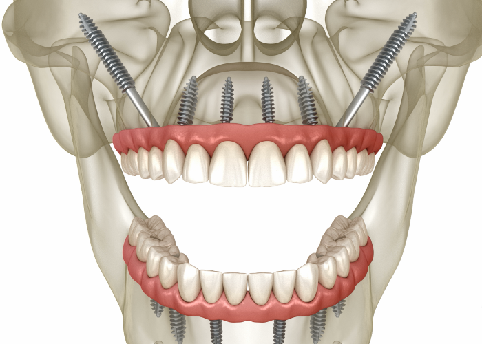 Treatments Zygomatic Implant