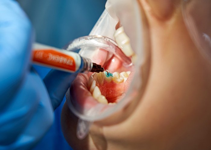 Application and Sculpting of Composite Material