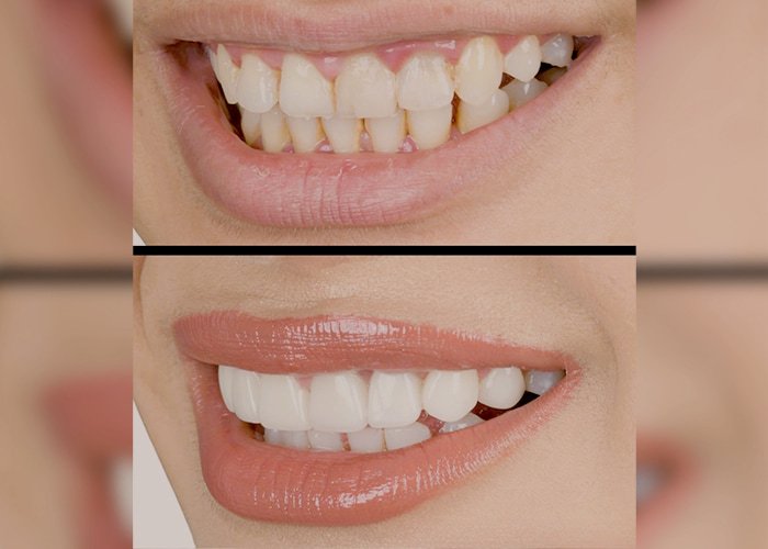 Turkey Teeth Packages: All-Inclusive Dental Packages Composite-Bonding-(Veneers)