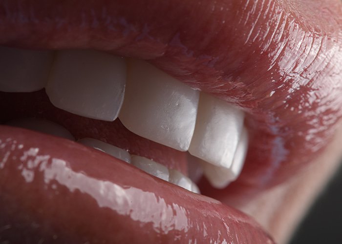 Composite-bonding-veneers