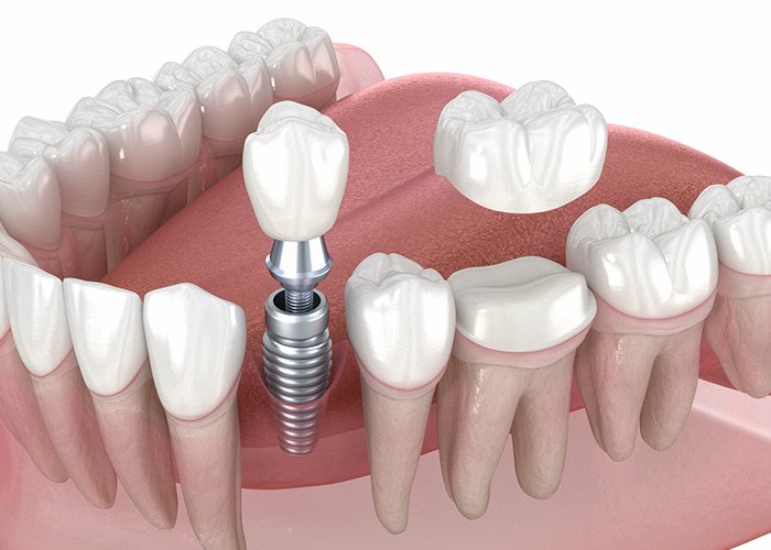 Is It Safe to Have Dental Implants in Turkey? Dental-implants-adn-crown