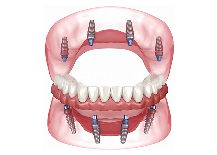 Tooth Implant Turkey Price 2025 – Complete Guide Full-Mouth-dental-implants