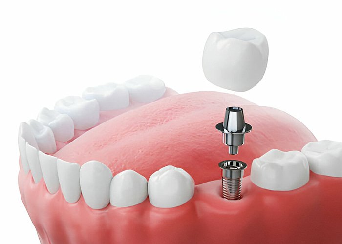 Turkey Teeth Packages: All-Inclusive Dental Packages Tooth-Implant-Turkey