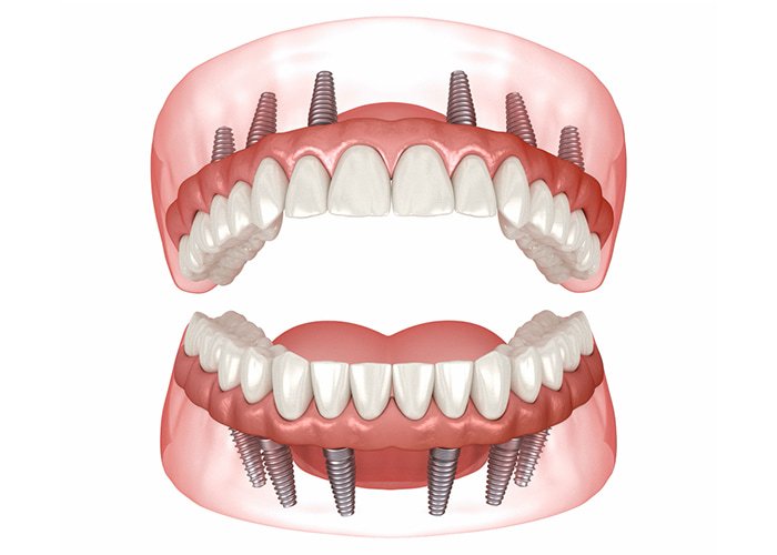 Full-Mouth-dental-implants