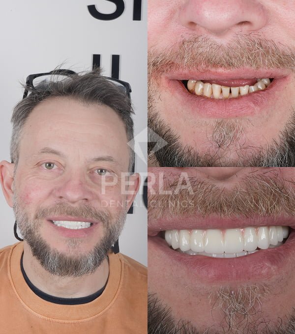All on 6 Dental treatment result