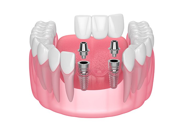 Implant-Supported-Dental-Bridge