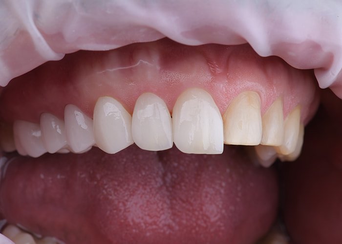 Laminate-Veneer-Placement-and-Bonding