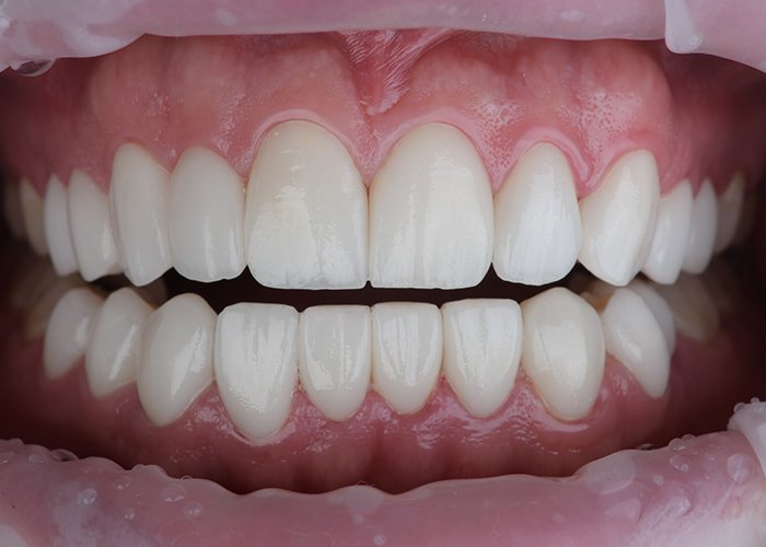 Laminate-Veneers-Finish-Results
