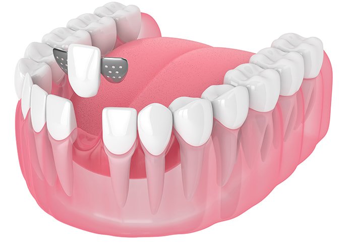 Maryland-(Resin-Bonded)-Bridge