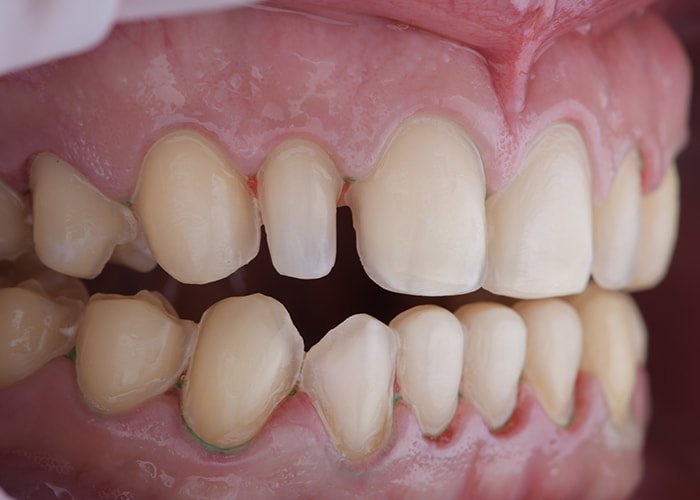 Preparation teeth for laminate veneers