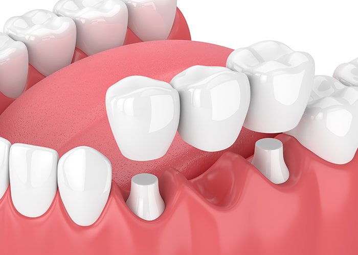 Traditional-dental-bridge