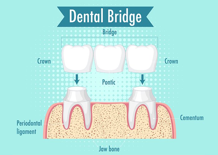 dental-bridge