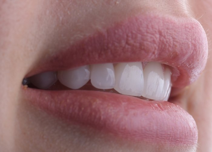 E-max veneers