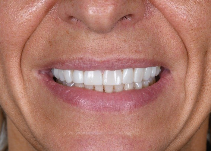 E-max vs Composite Bonding