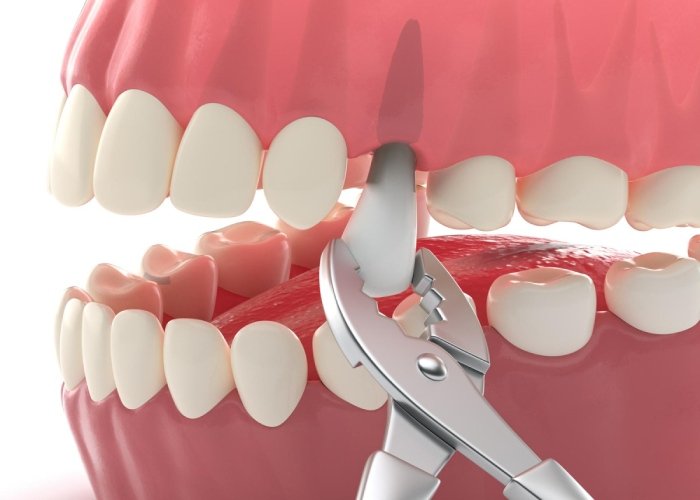 Tooth extraction