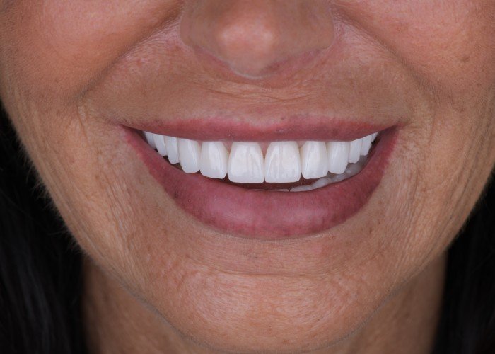 after zirconia crowns