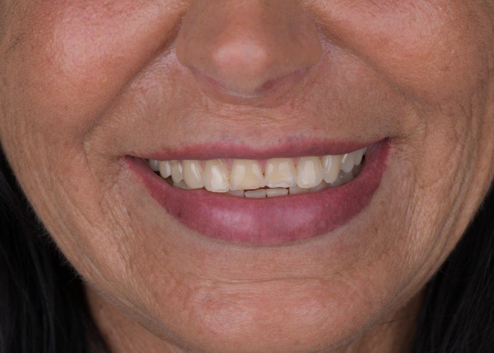 before zirconia crowns