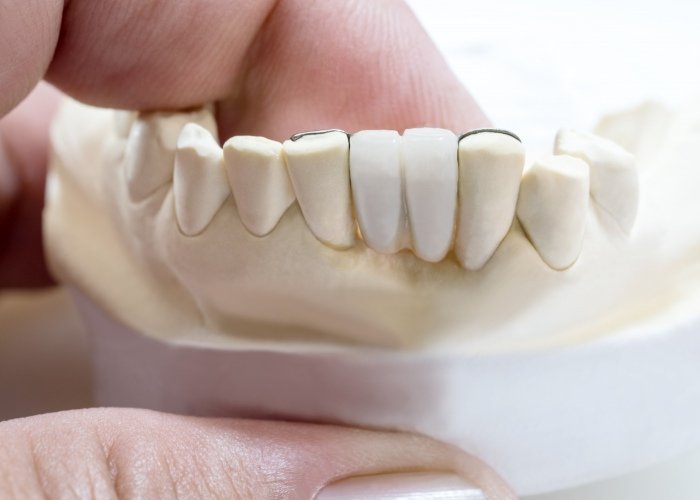 dental maryland bridge