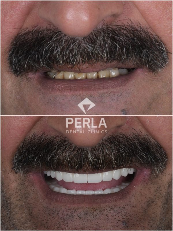 3 on 6 Dental Implants before-and-after results of 3-on-6