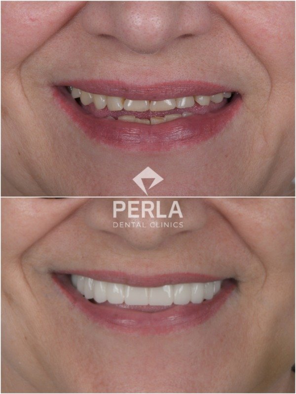 3 on 6 Dental Implants before-and-after results of 3-on-6