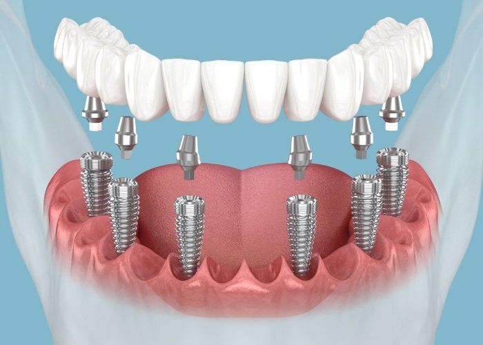 3 on 6 Dental Implants 3 on 6 Dental Implants 1