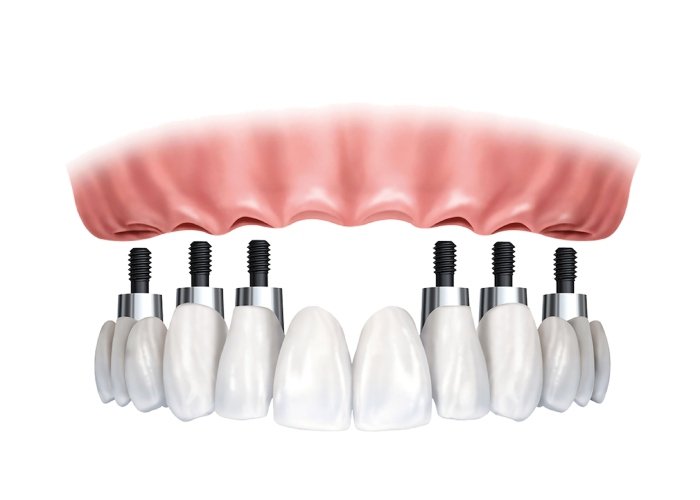 3-on-6 Dental Implants