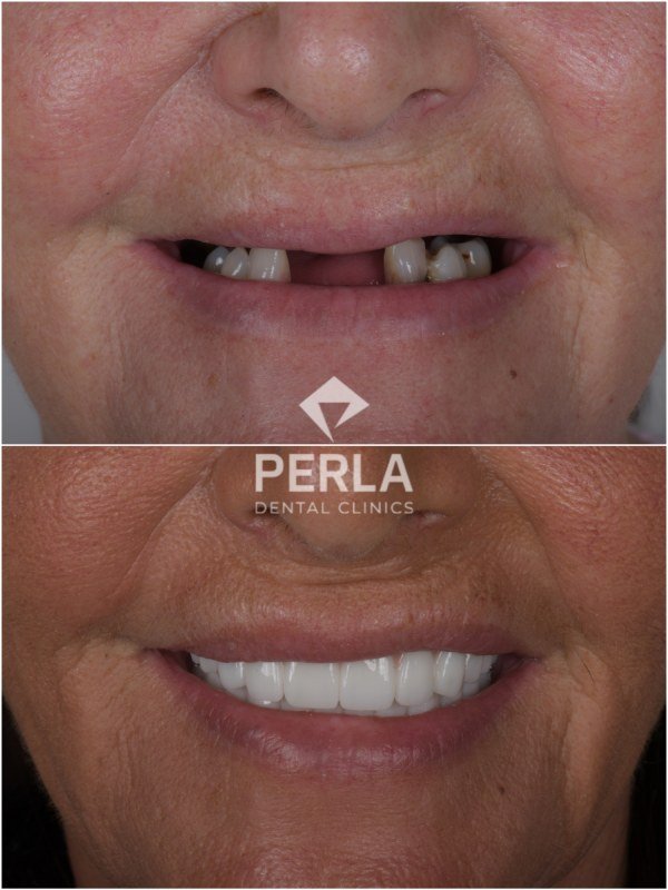 3 on 6 Dental Implants before-and-after results of 3-on-6